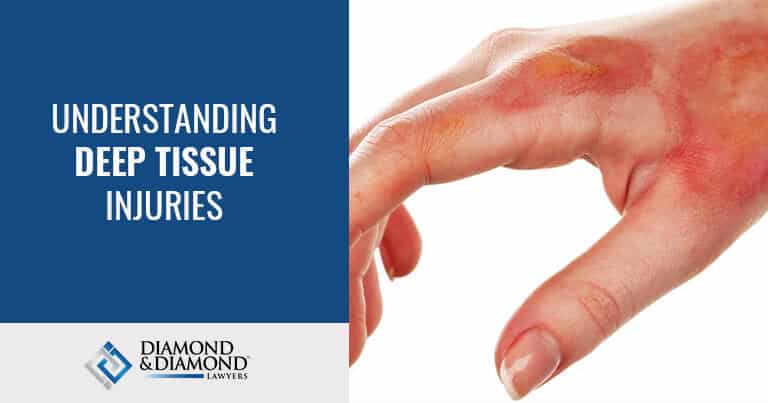 Home Understanding Deep Tissue Injuries